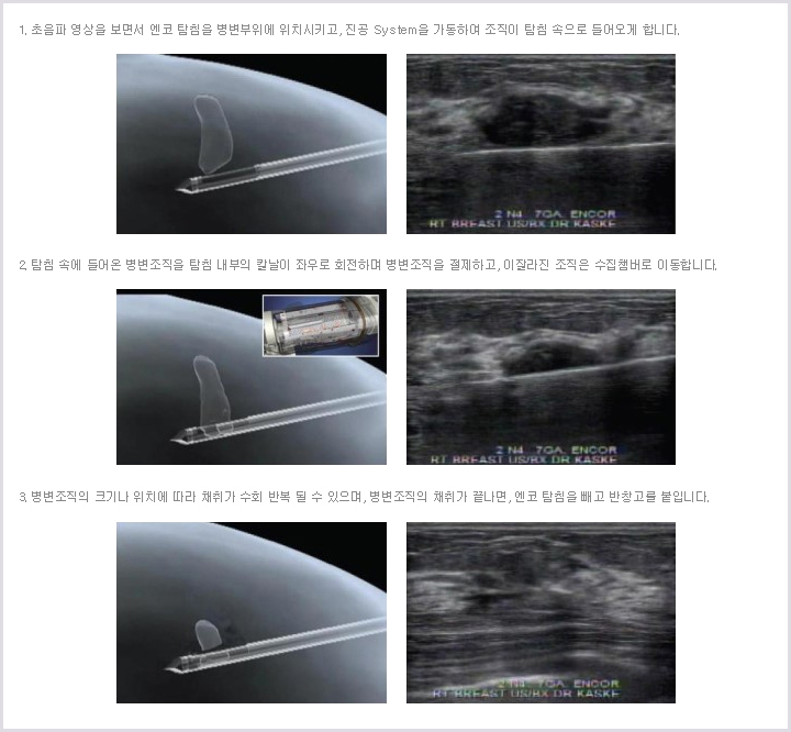 엔코 시술의 원리